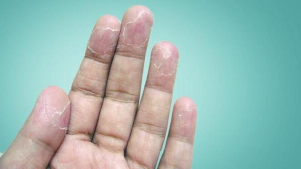 از دلیل تا درمان پوسته پوسته شدن انگشتان دست