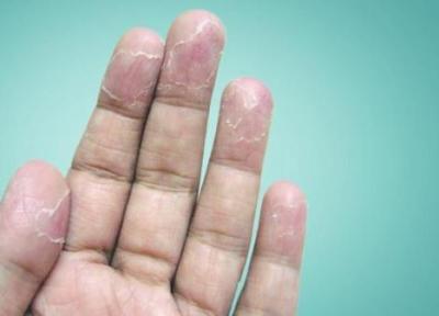 از دلیل تا درمان پوسته پوسته شدن انگشتان دست