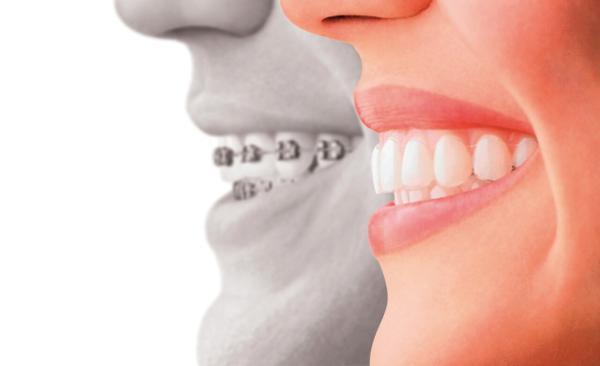 برترین نوع ارتودنسی چیست؟ ، دندان های مرتب؛ دغدغه ای چند هزارساله